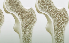 Dicas para previnir a osteoporose
