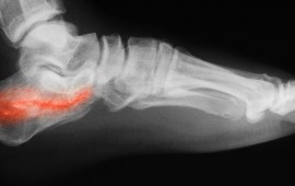 Fraturas do Calcâneo: Reabilitação e Recuperação