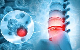 Tumor na Coluna