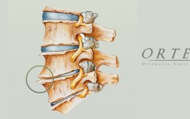 O que são osteófitos?
