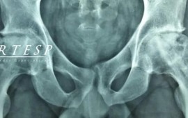 Osteonecrose no quadril