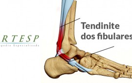 Tendinopatia dos fibulares, o que é?